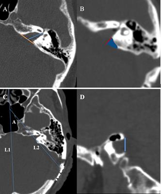 Analysis of the effect of neuroendoscopy-assisted microscopy in the treatment of Large (Koos grade IV) vestibular schwannoma